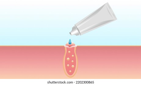 The Process Of Eliminating Acne, Cleaning Pores, Skin Treatment, Exposure To Gel, Ointment, Medical Product, Cream From A Metal Tube. Dermatological And Educational Sphere.