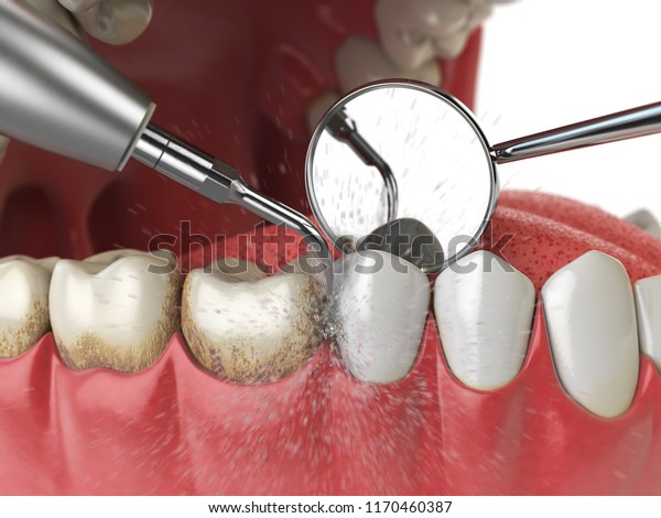 Professional\
teeth cleaning. Ultrasonic teeth cleaning machine delete dental\
calculus from human teeth. 3d\
illustration
