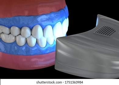 Proffesioinal Teeth Whitening, Light-activation On Tooth Bleaching. 3D Illustration Concept.