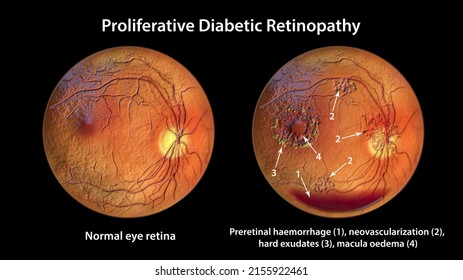 Proliferative Diabetic Retinopathy, 3D Illustration Showing Preretinal Haemorrhage As Horizontal Blood Level, Neovascularization In The Disk And Other Sites, Macula Edema And Hard Exudates