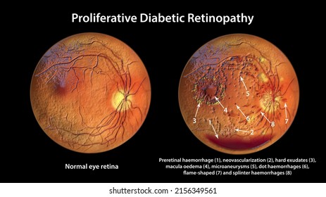 Proliferative Diabetic Retinopathy, 3D Illustration Shows Preretinal Haemorrhage, Neovascularization, Macula Edema, Hard Exudates, Cotton Wool Spots, Microaneurysms, Small Haemorrhages, Venous Beading