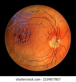 Proliferative Diabetic Retinopathy, 3D Illustration Showing Neovascularization In The Disk And Macula Edema. Abnormal Finding On Fundoscopic Examination Of The Eye Retina In Diabetes Mellitus