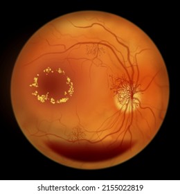 Proliferative Diabetic Retinopathy, Illustration Showing Preretinal Haemorrhage As Horizontal Blood Level, Neovascularization In The Disk And Other Sites, Macula Edema And Hard Exudates