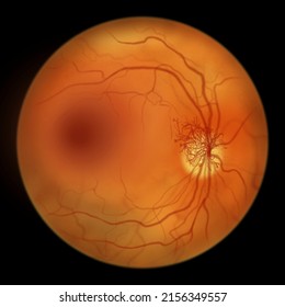 Proliferative Diabetic Retinopathy, Illustration Showing Neovascularization In The Disk And Macula Edema. Abnormal Finding On Fundoscopic Examination Of The Eye Retina In Diabetes Mellitus