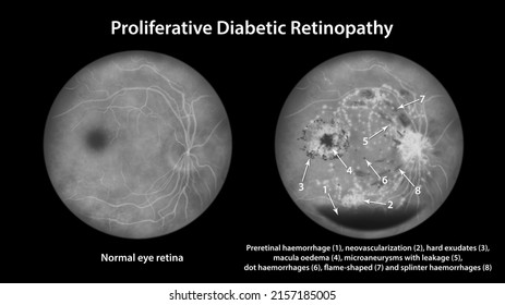 Proliferative Diabetic Retinopathy, Illustration Showing Preretinal Haemorrhage, Neovascularization, Macula Edema, Hard Exudates, Microaneurysms, Small Haemorrhages, Fluorescein Angiography