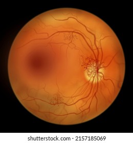 Proliferative Diabetic Retinopathy, Illustration Showing Neovascularization In The Disk And Other Sites, And Macula Edema. Fundoscopic Examination Of The Eye Retina In Diabetes Mellitus