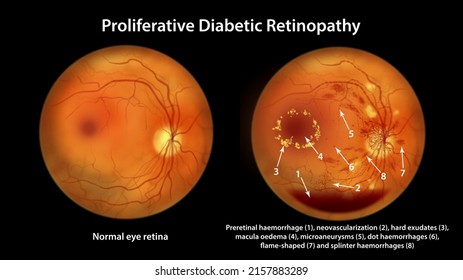 Proliferative Diabetic Retinopathy, Illustration Showing Preretinal Haemorrhage, Neovascularization, Macula Edema, Hard Exudates, Cotton Wool Spots, Microaneurysms, Small Haemorrhages, Venous Beading