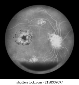 Proliferative Diabetic Retinopathy, Illustration Showing Preretinal Haemorrhage, Neovascularization In The Disk And Other Sites, Cystoid Macula Edema And Hard Exudates, Fluorescein Angiography