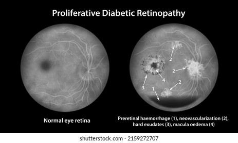 Proliferative Diabetic Retinopathy, Illustration Showing Preretinal Haemorrhage, Neovascularization In The Disk And Other Sites, Cystoid Macula Edema And Hard Exudates, Fluorescein Angiography