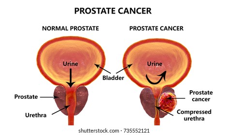 Cancer de la prostate, illustration 3D montrant la prostate normale et la présence d'une tumeur à l'intérieur de la prostate qui compresse l'urètre