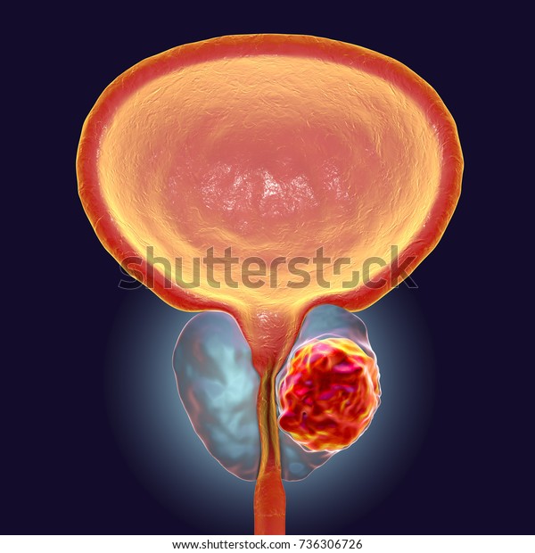 Prostate cancer, 3D\
illustration showing presence of tumor inside prostate gland which\
compresses\
urethra