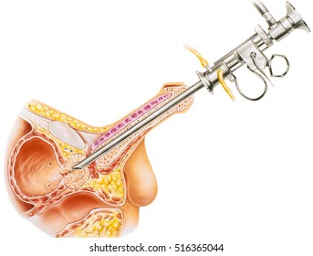 Prostate - Transurethral Resection Procedure of the prostate. A surgical procedure to remove tissue from the prostate using a resectoscope inserted through the urethra.
