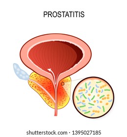 e coli la prostata e coli la prostata