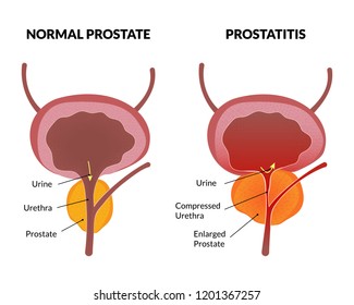 exacerbations a prostatitis