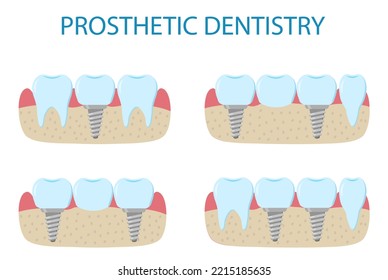 Prosthetic Dentistry Poster. Icons Of Different Variants Of Implant Prosthetics. Human Tooth In Flat Style.   Illustration Isolated