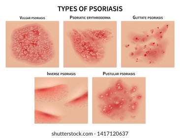 443 Types psoriasis Images, Stock Photos & Vectors | Shutterstock