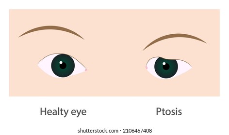 Ptosis. Normal Eye And A Drooping Of The Upper Eyelid Illustration.