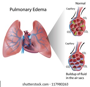 Pulmonary Edema