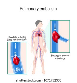 Pulmonary Embolism. Human Silhouette With Highlighted Circulatory System. Close-up: Blood Clot In The Leg (deep Vein Thrombosis), And Blockage Of A Vessel In The Lungs