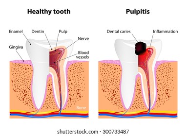 Pulpitis And Healthy Tooth