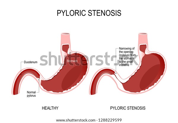 Pyloric Stenosis Narrowing Opening Pylorus Stomach Stock Illustration ...