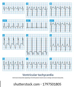 The QRS Complex Was In The Form Of Complete Right Bundle Branch Block Combined With Left Anterior Branch Block.