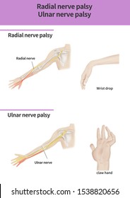 Radial Nerve Palsy Ulnar Nerve Palsy 