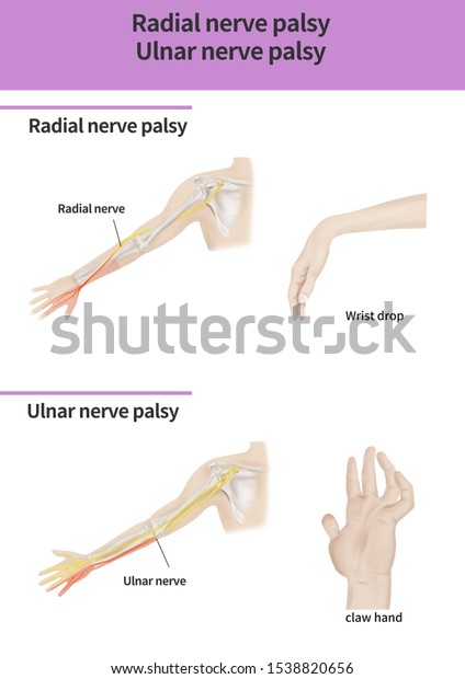 Radial Nerve Palsy Ulnar Nerve Palsy Stock Illustration 1538820656