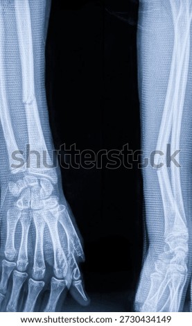Radiography scan of broken arm bone immobilized with plaster cast, Oblique radial shaft fracture diagnosis.