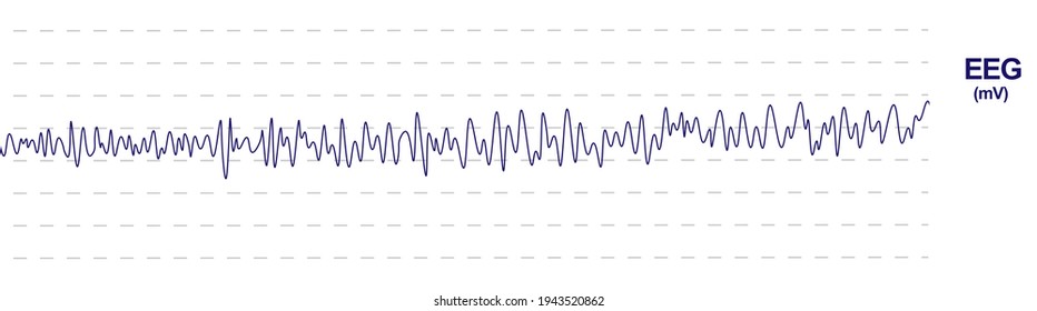 
Raw Electroencephalogram(EEG) Monitoring. EGG Waveform Monitor Screen.