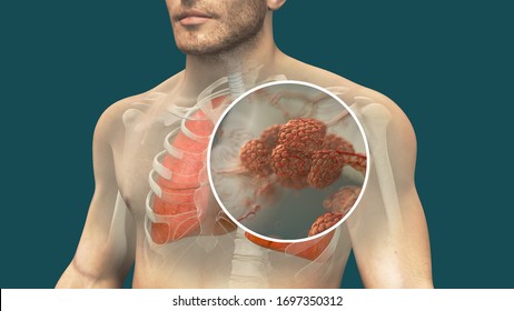 Realistic 3d Illustration Of Human Lungs And Pulmonary Alveolus