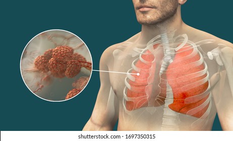 Realistic 3d Illustration Of Human Lungs And Pulmonary Alveolus