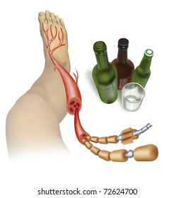 Realistic Illustration On Neuropathy