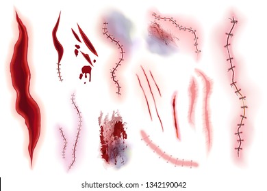 Realistic Surgical Stitches, Scars, Bruise And Slaughter Set Isolated On The Alpha Transperant Background. Bloody Scar.