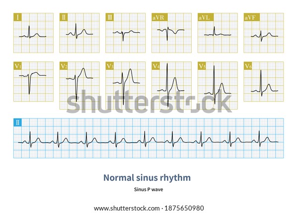 Recognizing Normal Sinus Rhythm Basis Learning Stock Illustration ...