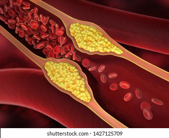 Red Blood Cells - Narrowing Of A Blood Vessel - Erythrozyt 3d Illustration