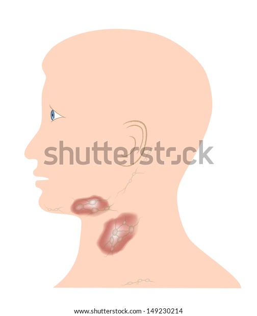 Red Swollen Lymph Nodes Lymphadentis Stock Illustration 149230214