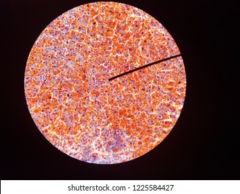 The Red-brown Glandular Material Seen Here With A Copper Stain Is Excessive Lysosomal Copper Owing To The Rare Autosomal-recessive Disorder Wilson Disease.