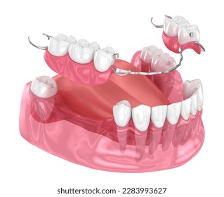 Removable partial denture, mandibular prosthesis. Medically accurate 3D illustration of prosthodontics concept