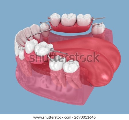 Removable partial denture, mandibular prosthesis. Medically accurate 3D illustration of prosthodontics concept