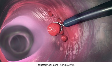 Removal of a colonic polyp with a electrical wire loop during a colonoscopy - 3d illustration