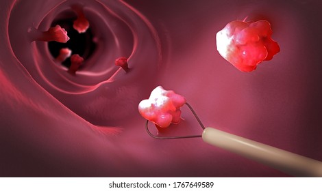 Removal of a colonic polyp with a electrical wire loop during a colonoscopy - 3d illustration