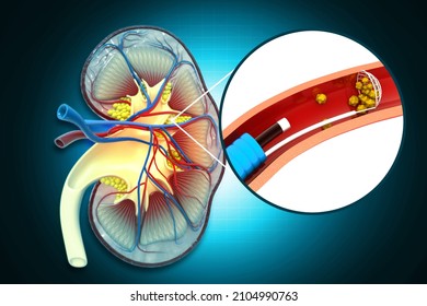 Remove Kidney Stones. 3d Illustration