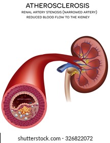 Renal Artery Disease. Atherosclerosis Progression At The End Blocked Blood Flow