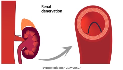 Renal Denervation Illustration. RDN Treatment For Hypertension. Renal Artery Cross Section View