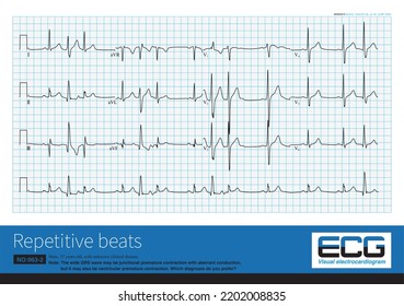 Repetitive Beats.Ventricular And Junctional Premature Contractions Can Activate The Ventricle Again Through The Reentry Mechanism To Form The Complex Arrhythmia Of Repetitive Beats.