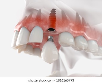 Replacement of maxillary canine with a dental implant. Realistic 3d illustration.
