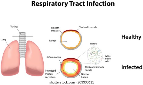 Respiratory Tract Infection Images Stock Photos Vectors Shutterstock