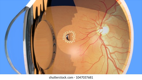 Retina After Tear Laser Photocoagulation, 3d Render, 4K Video Available, Clip Id 1006730719