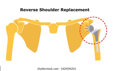 Reverse Shoulder Replacement. Shoulder Joint Replacement, Endoprosthetics. Osteoarthrosis Of The Shoulder Joint.  Flat Design.